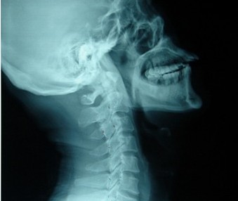 颈椎管狭窄症状